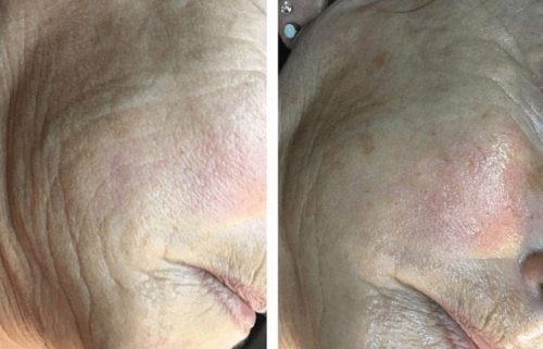 Calmante_schoonheidsinstituut-schoonheidssalon-Kempen-Westerlo-Afslanken-Huidverbetering-Verzorging-Cryo21_Arctik21_Dreamshaper-Revive_Restart